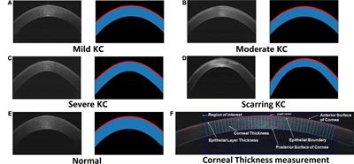 Dissecting the Profile of Corneal Thickness With Keratoconus Progression Based on Anterior Segment Optical Coherence Tomography